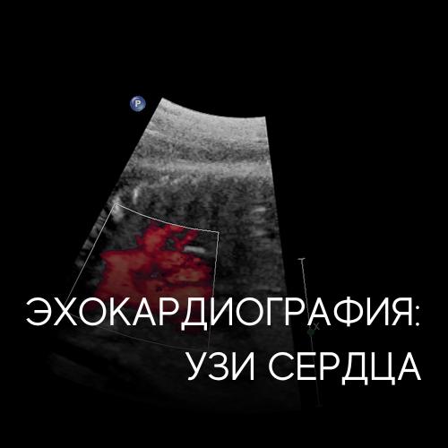 УЗИ сердца (эхокардиография) — диагностика, которая может спасти жизнь