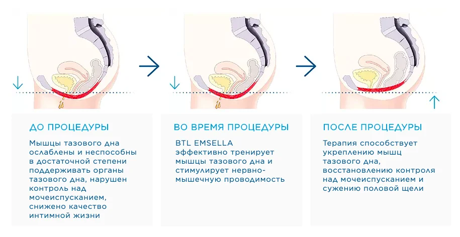 Атрофия мышц тазового дна — диаграмма