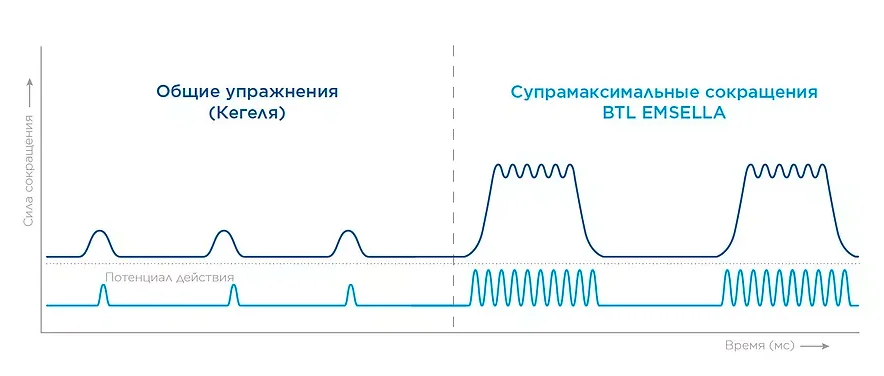 Сравнение: упражнения Кегеля vs EMSELLA